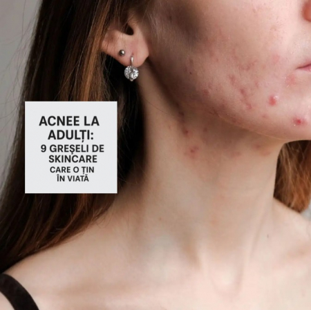 Acnee la adulți: 9 greșeli de skincare care o țin în viață