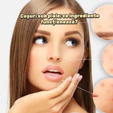 Coșuri sub piele: ce ingrediente funcționează? Coșuri sub piele: ce ingrediente funcționează?