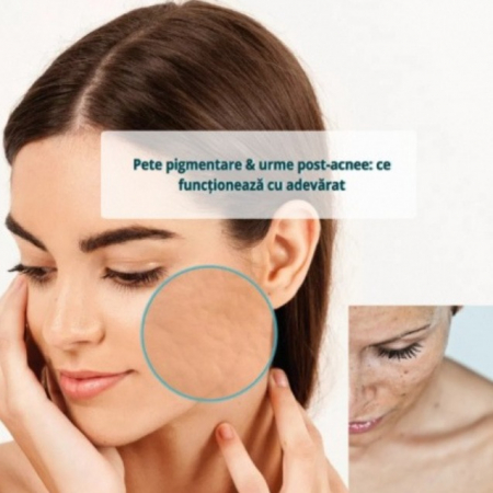 Pete pigmentare & urme post-acnee: ce funcționează cu adevărat