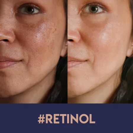 Tot ce ar trebui să stii despre Retinol: Aplicare Corectă, Beneficii, Produse Eficiente și Efecte Secundare